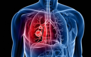 肺部肿瘤的三大主要症状