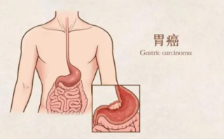 胃癌早期常见的七种症状
