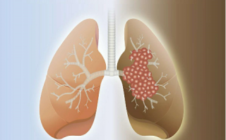 肺癌缓解期的怎么护理好