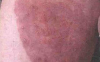 什么是真菌性皮肤病？
