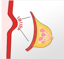 乳腺增生是什么病？