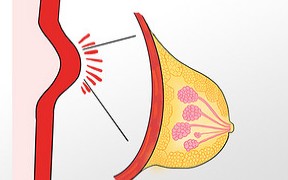乳腺增生是什么病？
