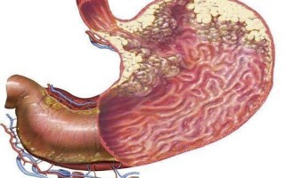 胃癌如何选择正确的治疗方法