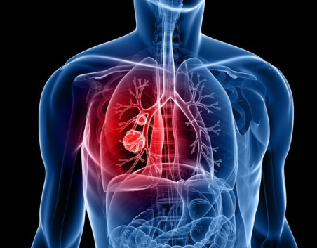 肺上有肿瘤怎么办-第1张图片-中国中医健康网