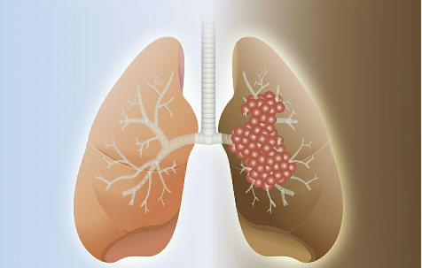 经常胸痛、咳嗽？出现这3这种症状要警惕是肺癌-第1张图片-中国中医健康网