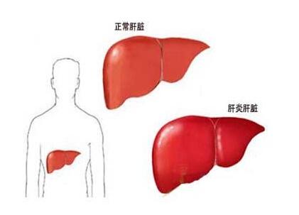 为什么中国是肝癌高发地？-第1张图片-中国中医健康网